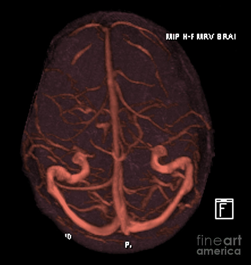 Intracranial Magnetic Resonance Venogram #3 Photograph by Medical Body Scans