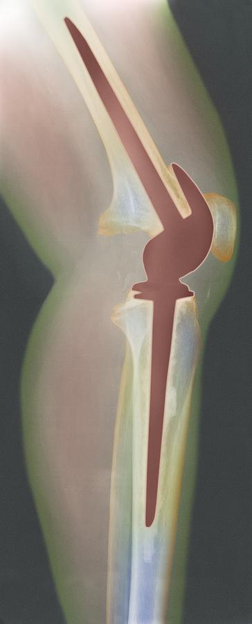 Knee Photograph - Knee Replacement, X-ray #3 by 