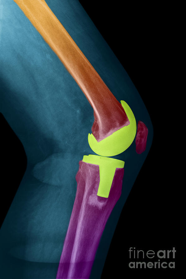 Knee Replacement X-ray #3 Photograph by Ted Kinsman