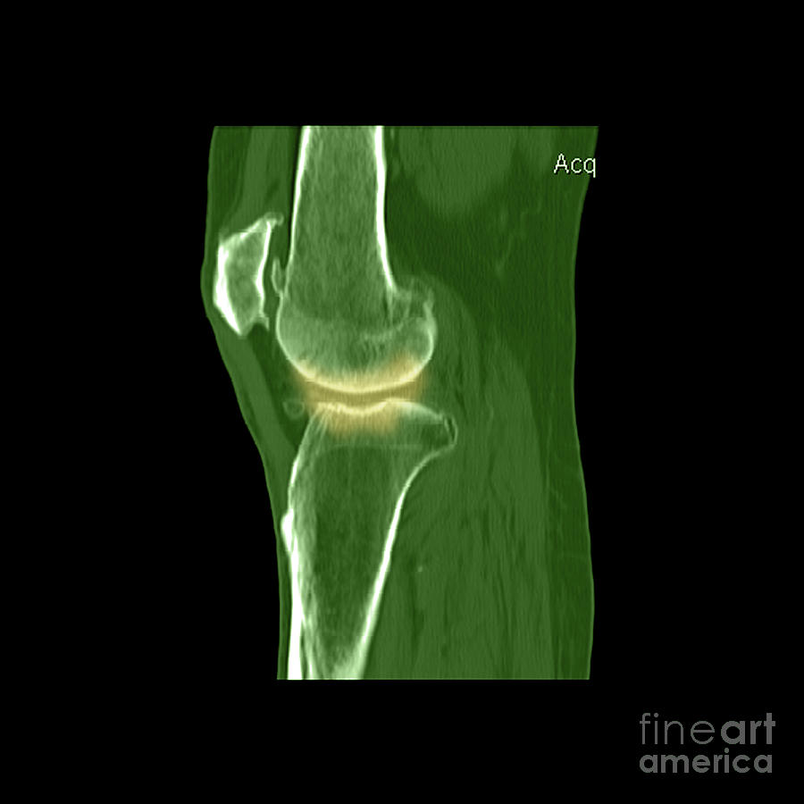 Knee Showing Osteoporosis #3 Photograph by Medical Body Scans