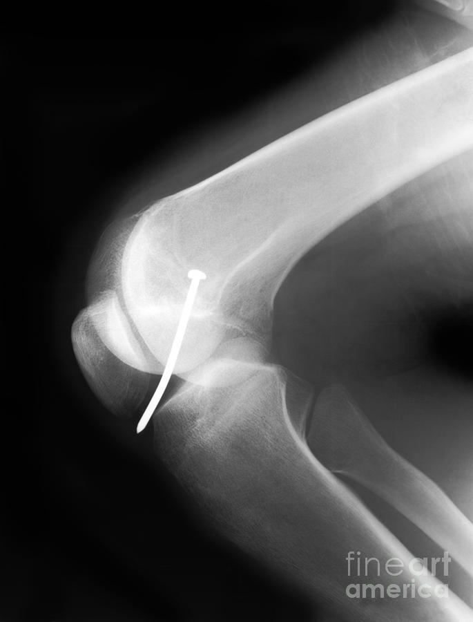 Knee X-ray #3 Photograph by Ted Kinsman