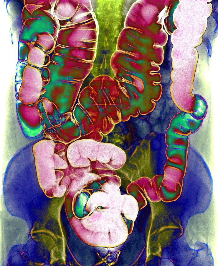 Coloured Photograph - Large Intestine, X-ray #3 by Du Cane Medical Imaging Ltd