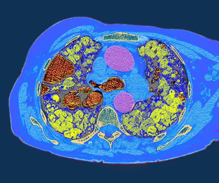 Lung Fibrosis Ct Scan Photograph By Du Cane Medical Imaging Ltd Pixels 2884