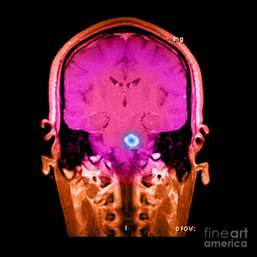 Mri Of Acute Ms #3 Photograph by Medical Body Scans