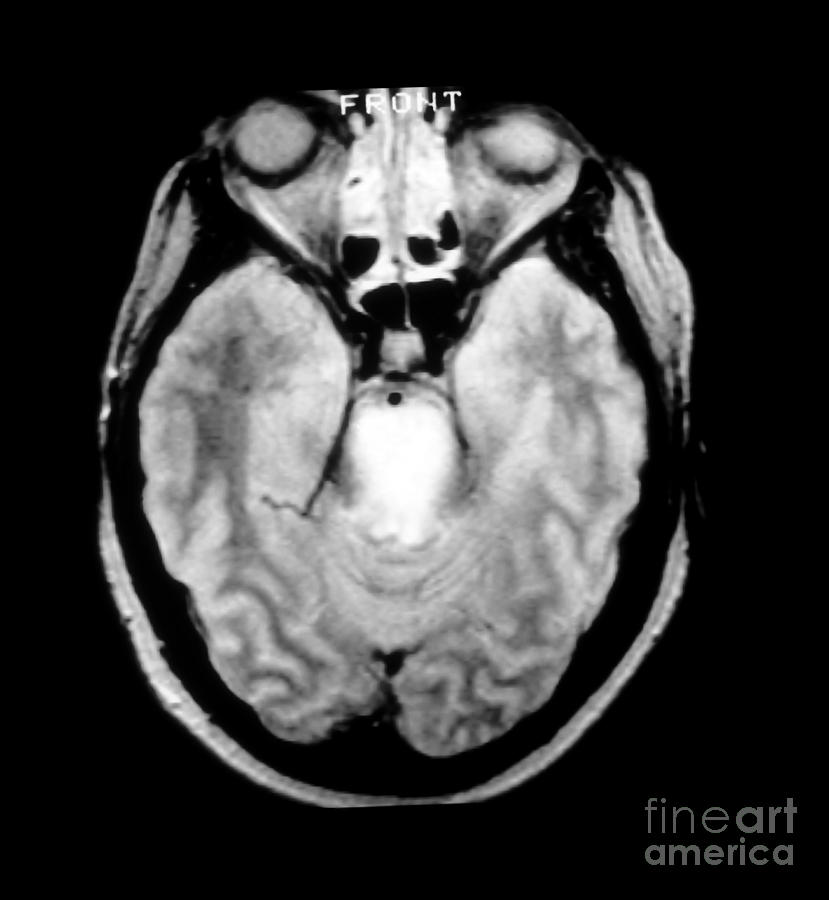 Mri Of Brainstem Glioma #3 Photograph by Medical Body Scans
