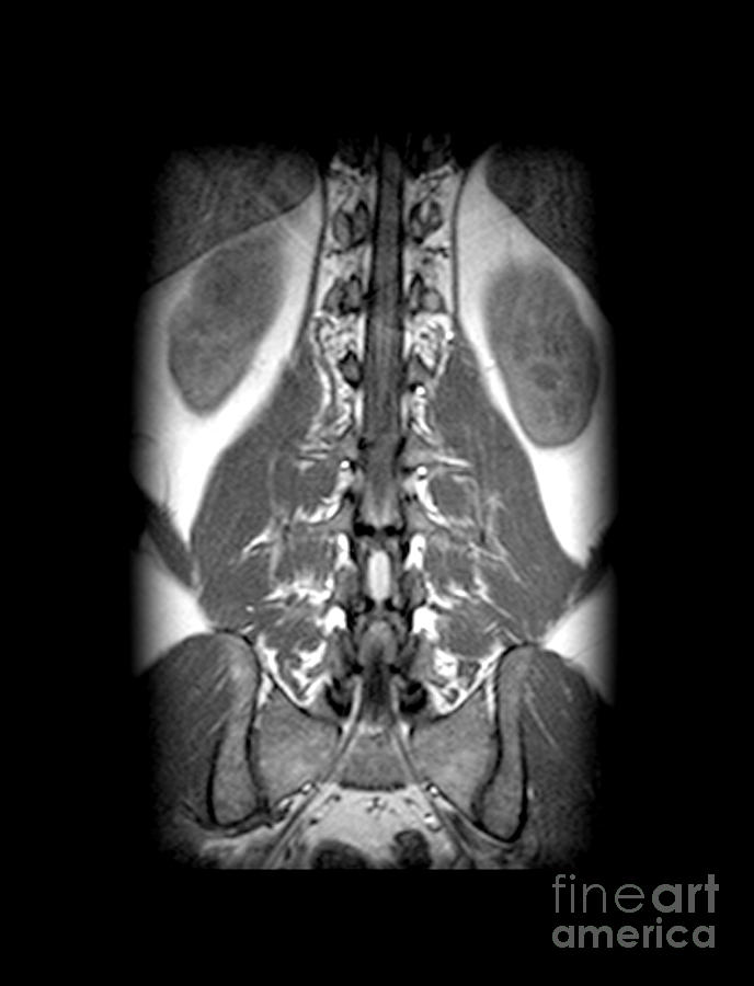 Mri Of Spinal Cord And Nerve Roots #3 Photograph by Medical Body Scans