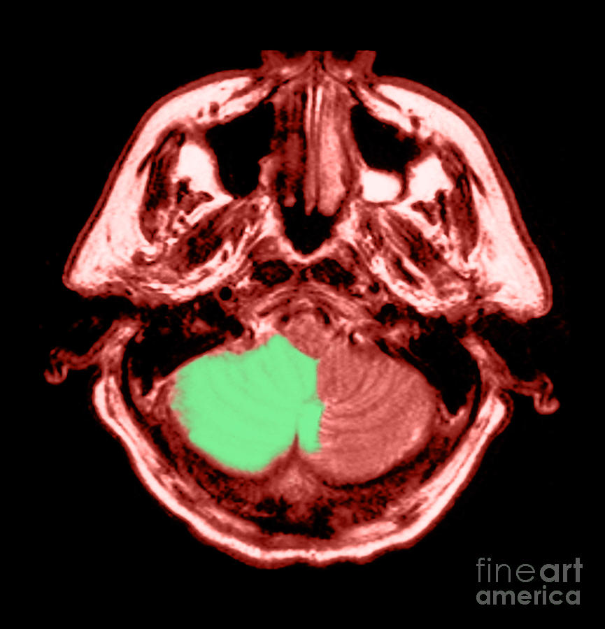 Mri Of Stroke #3 Photograph by Medical Body Scans
