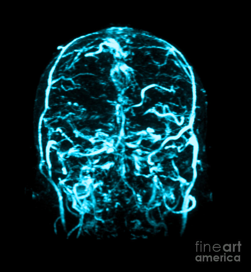Abnormal Mri Brain Photograph - Mri Of Venogram Of Dural Sinus #3 by Medical Body Scans