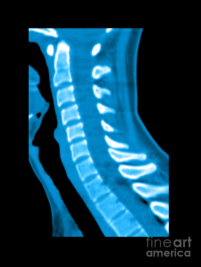 Normal Cervical Spine #1 Photograph by Medical Body Scans