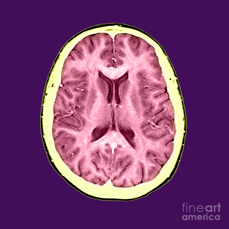 Normal Cross Sectional Mri Of The Brain #3 Photograph by Medical Body Scans