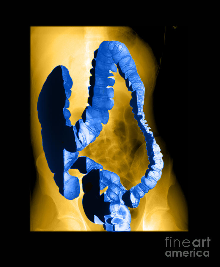 Normal Double Contrast Barium Enema #3 Photograph by Medical Body Scans