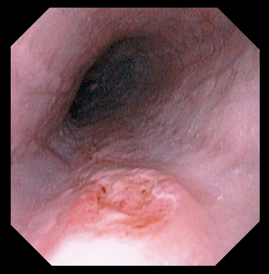 Oesophagus Ulcer Photograph - Oesophagus Ulcer #3 by David M. Martin, Md