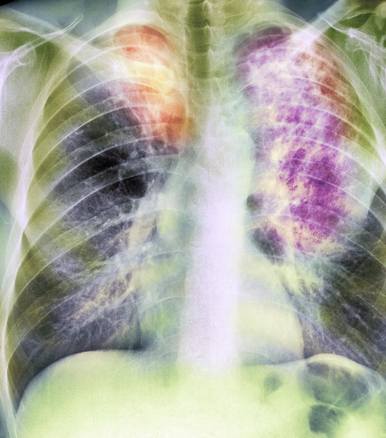 Old And New Tuberculosis, X-ray Photograph by - Fine Art America