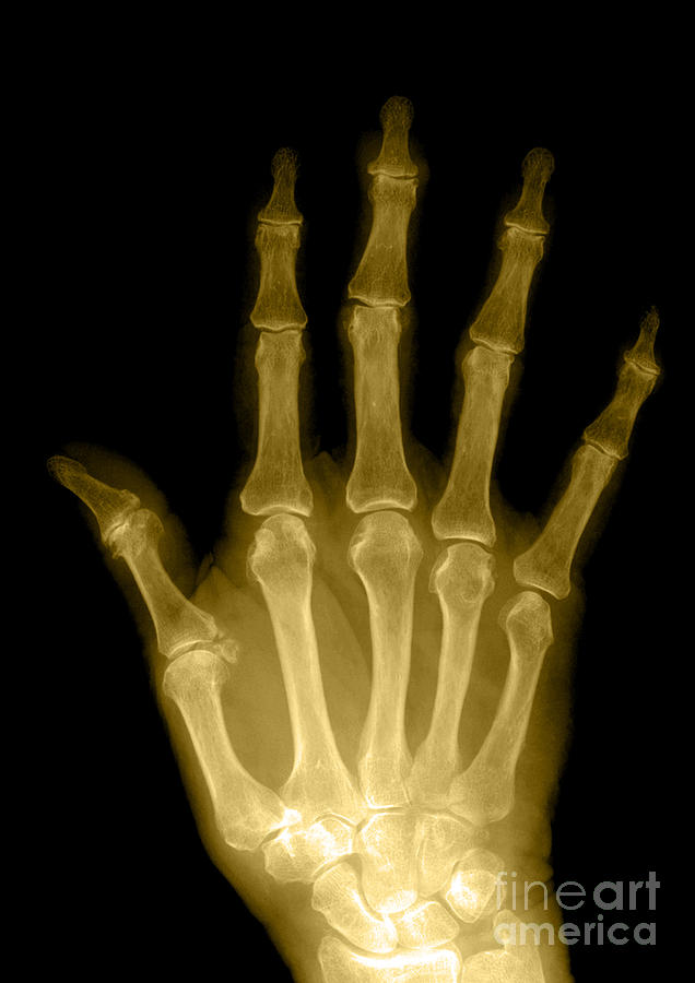 Skeleton Photograph - Osteoporosis And Degenerative Arthritis #3 by Medical Body Scans