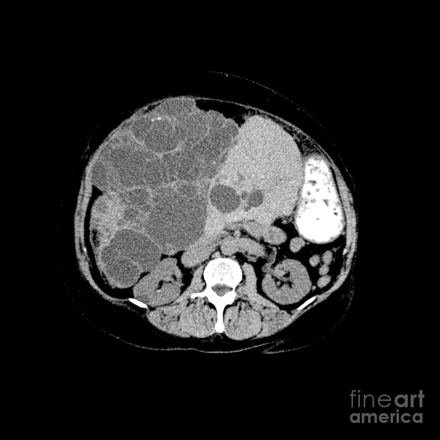 Polycystic Liver Disease On Ct Photograph by Medical Body Scans - Pixels