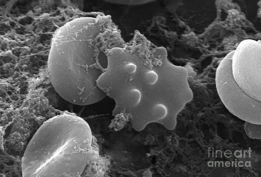 Biology Photograph - Red Blood Cells And Acanthocyte, Sem #3 by Science Source