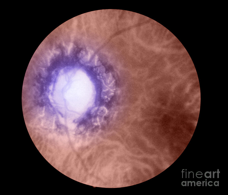 Retina Infected By Syphilis #3 Photograph by Science Source