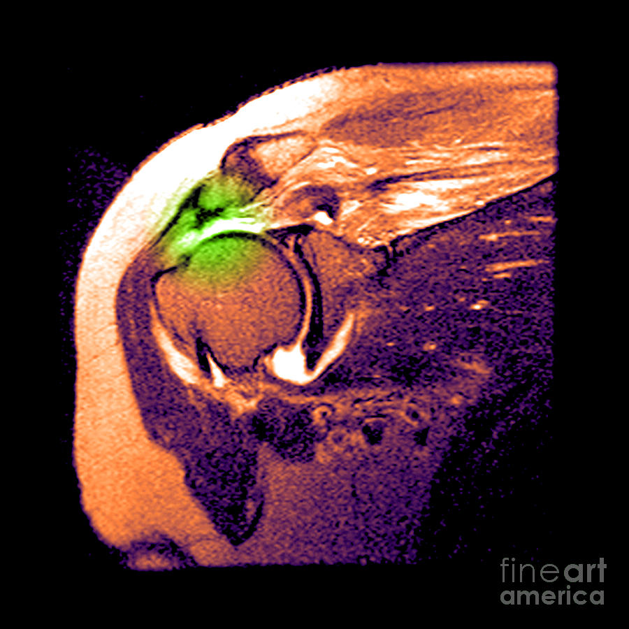 Rotator Cuff Tear #3 Photograph by Medical Body Scans