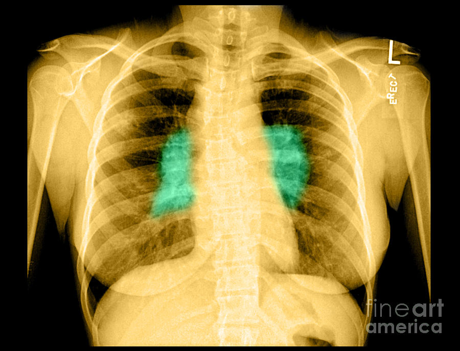 Chest Photograph - Sarcoidosis #3 by Medical Body Scans