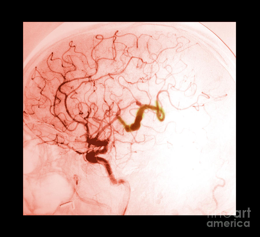 Serpentine Aneurysm #3 Photograph by Medical Body Scans