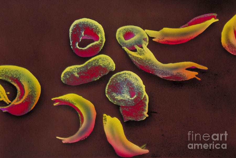 Sickle-cell Anemia, Sem #3 Photograph by Omikron