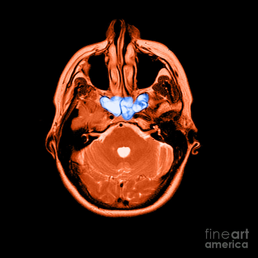 Sinusitis #3 Photograph by Medical Body Scans