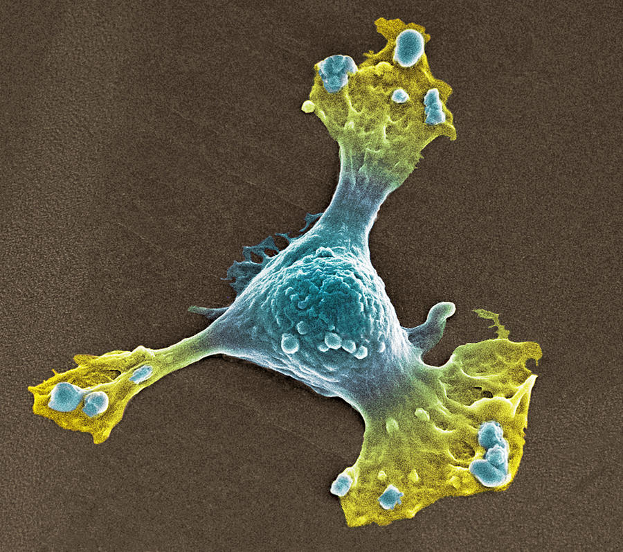 Melanoma Photograph - Skin Cancer Cell, Sem #3 by Steve Gschmeissner