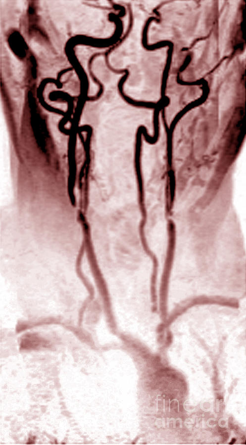 Stenosis Of The Internal Carotid #6 Photograph by Medical Body Scans