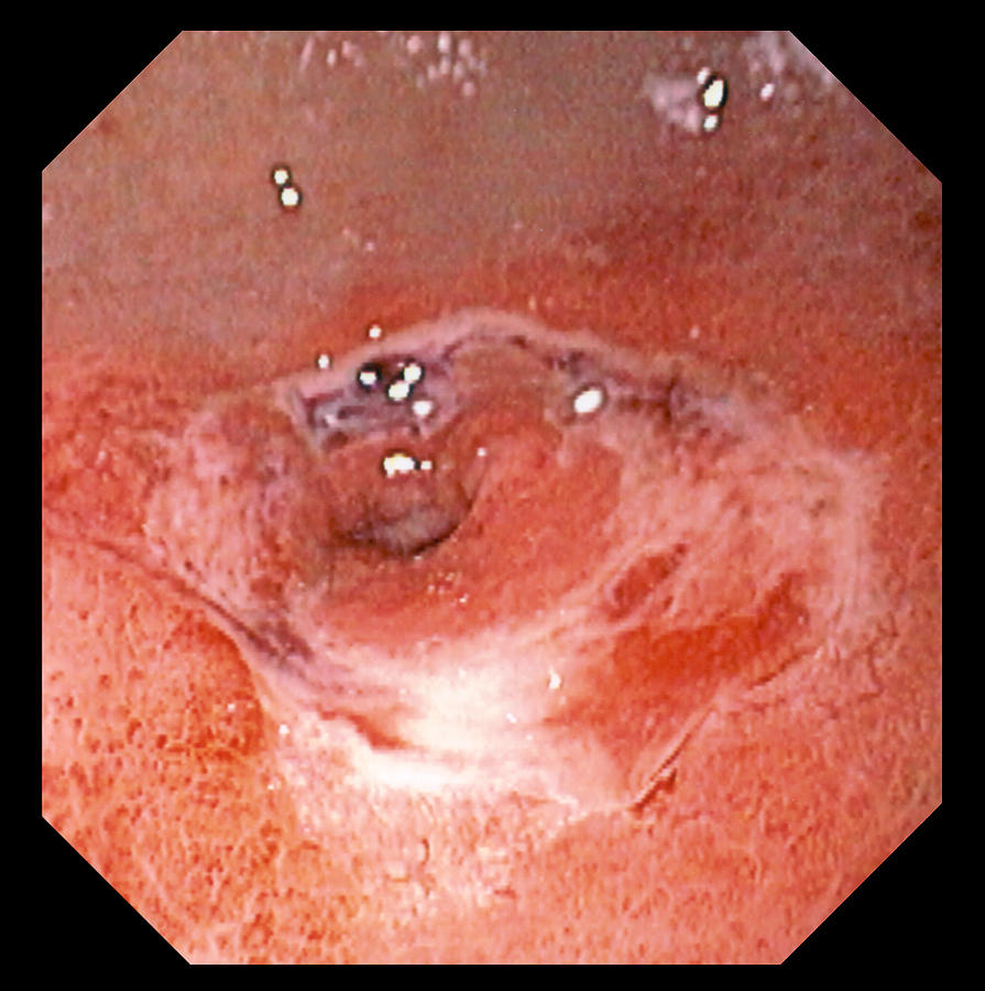 Gastric Ulcer Photograph - Stomach Ulcer #3 by David M. Martin, Md