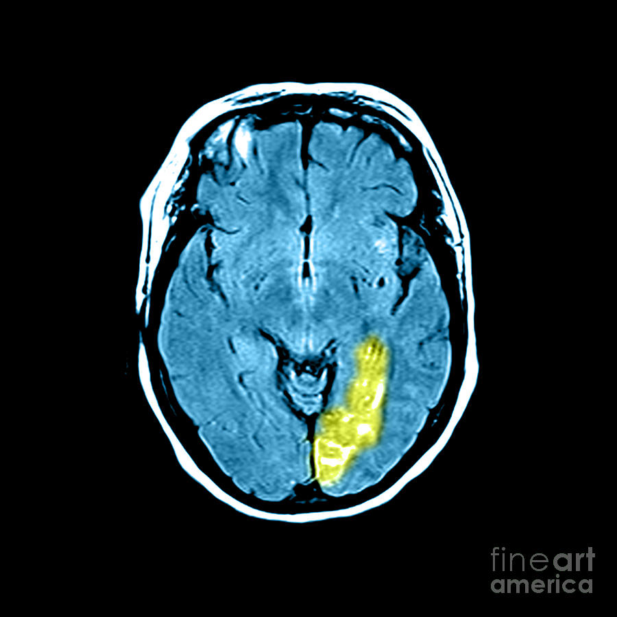 Stroke #3 Photograph by Medical Body Scans