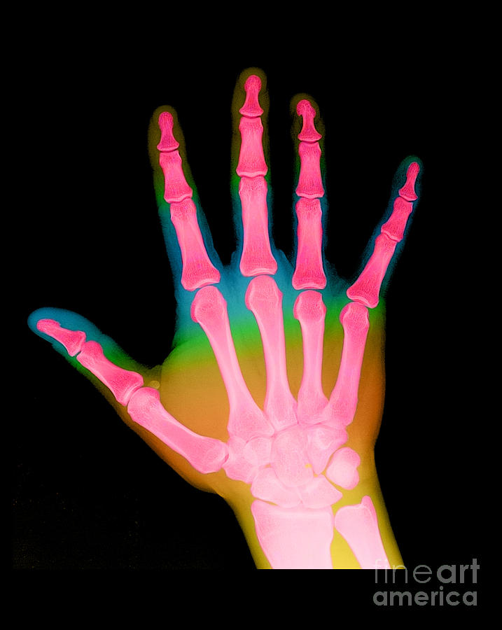 X-ray Of A Hand #3 Photograph by Medical Body Scans