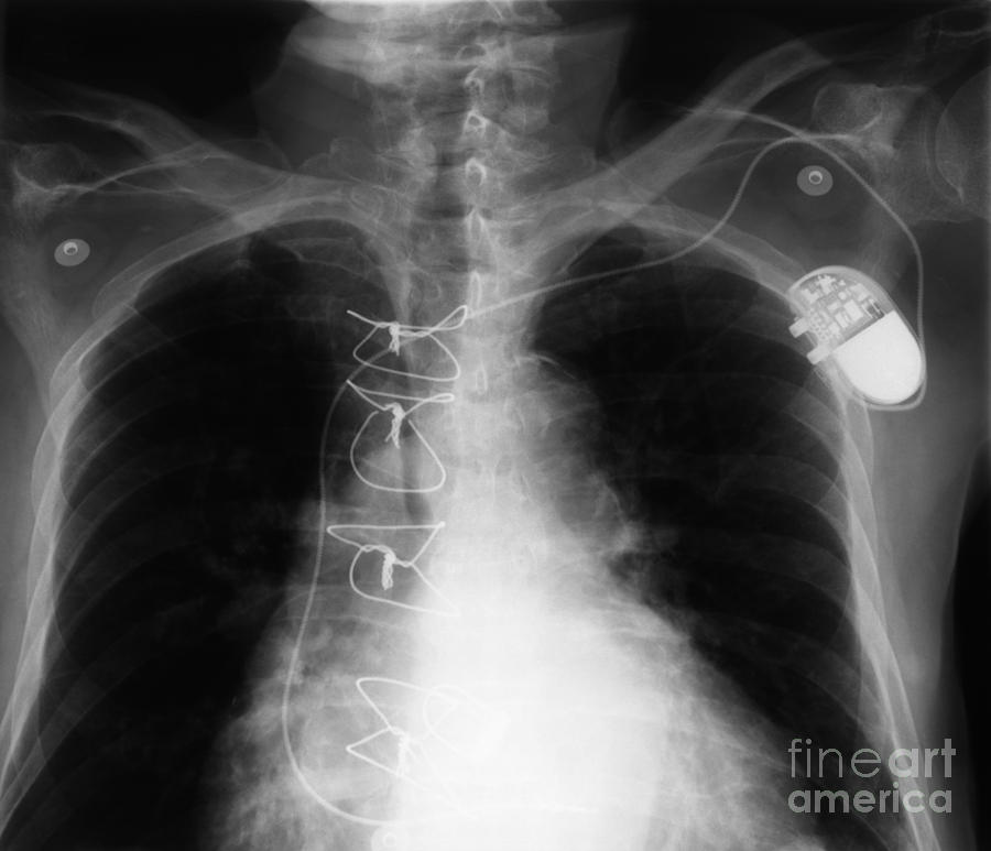 X-ray Of Implanted Defibulator #3 Photograph by Ted Kinsman