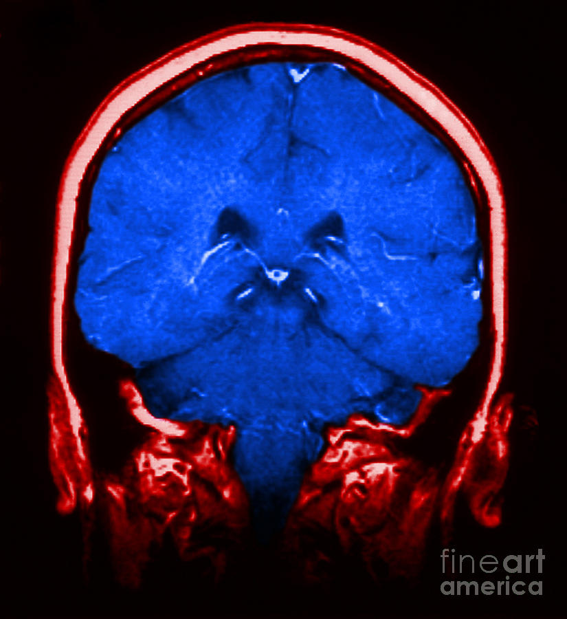 Brain Photograph - Mri Of Normal Brain #32 by Science Source