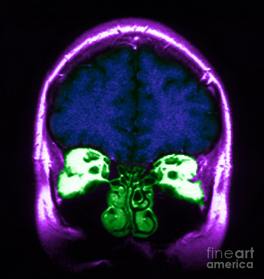 Mri Of Normal Brain #38 Photograph by Science Source