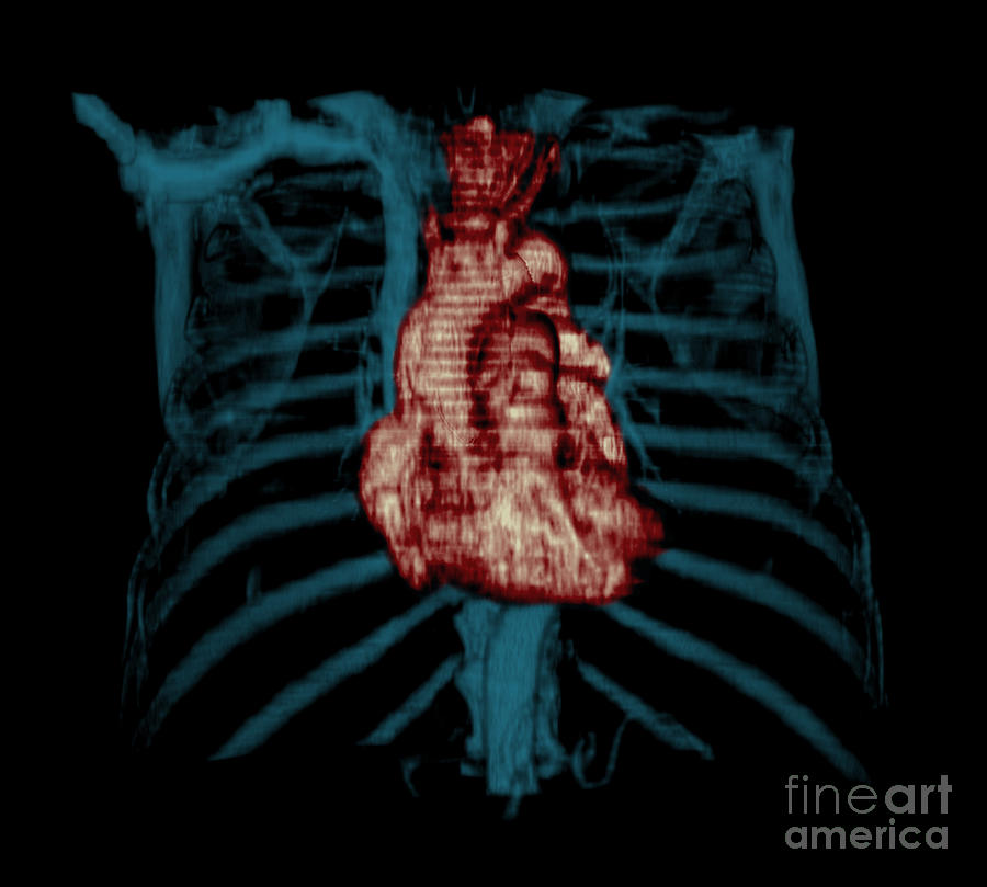 3d Ct Reconstruction Of Heart #4 Photograph by Medical Body Scans