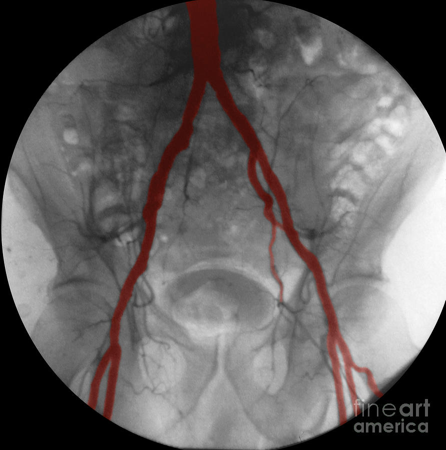 Angiogram Of Iliac Arteries #4 Photograph by Omikron