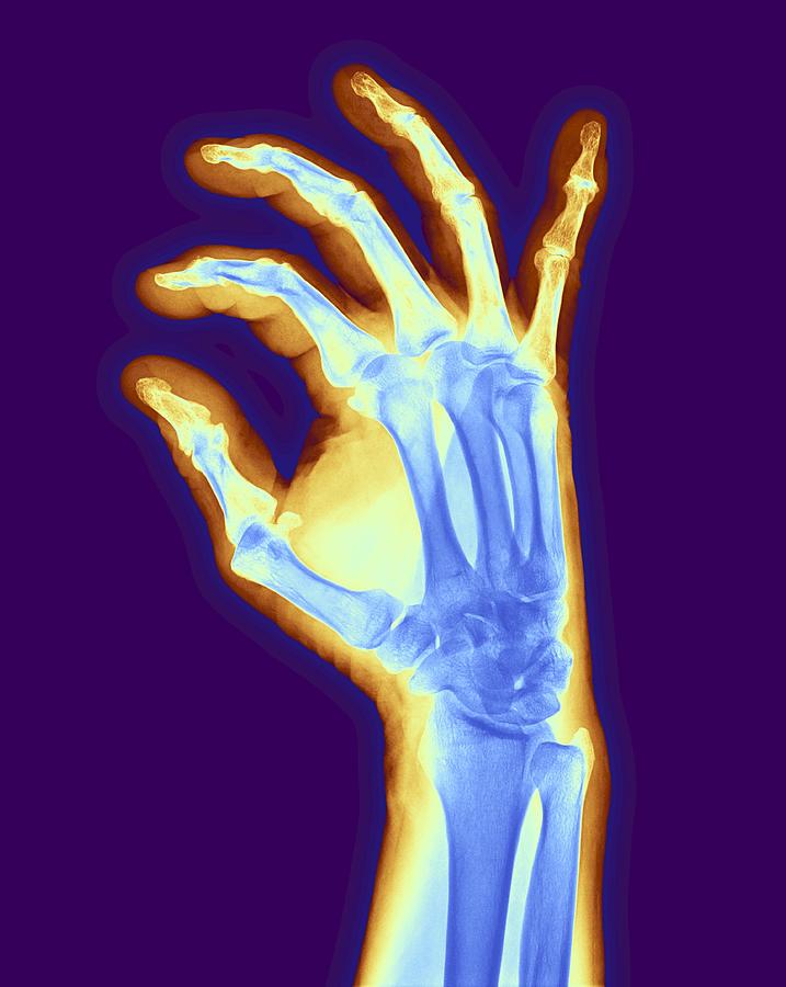 Arthritic Hand, X-ray #4 Digital Art by Pasieka