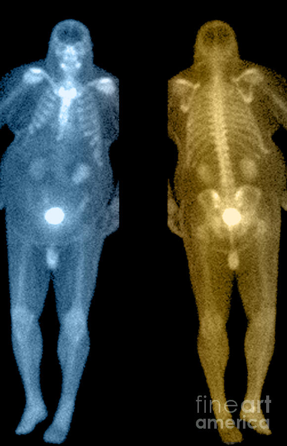 Bone Scan #4 Photograph by Medical Body Scans