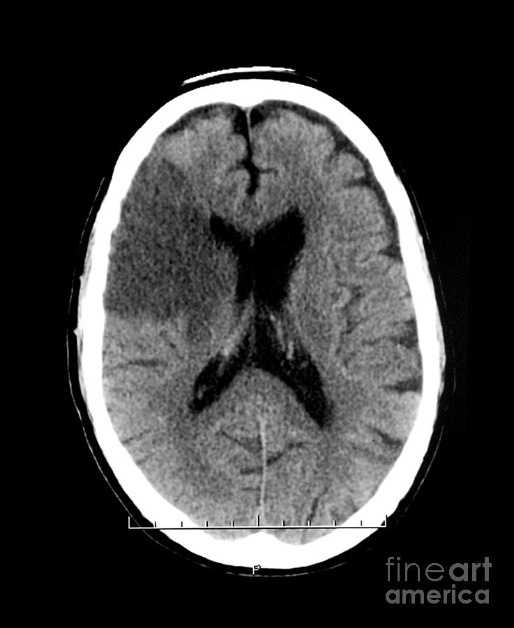 Ct Of Stroke Photograph by Medical Body Scans