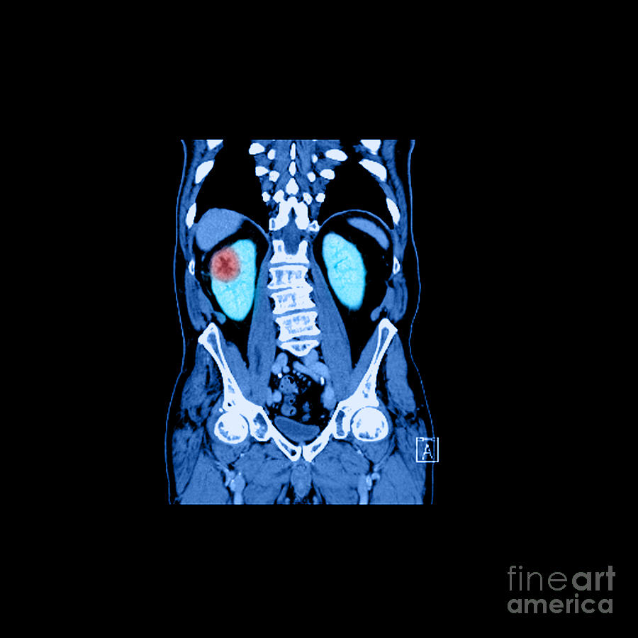 Ct Reconstruction Of Renal Cancer #4  by Medical Body Scans