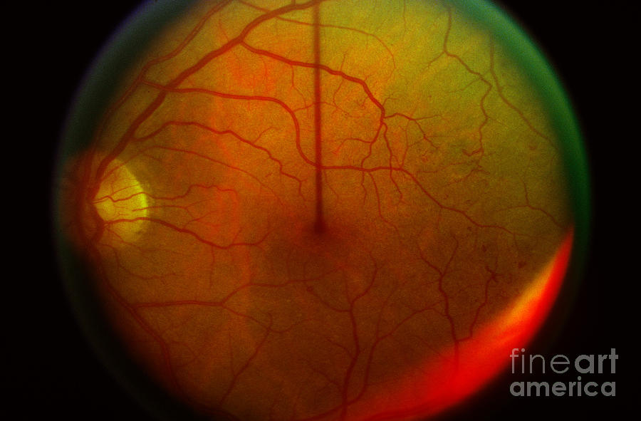 Diabetic Retinopathy #4 Photograph by Science Source