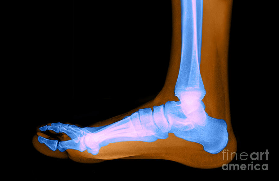 Flat Foot #4 Photograph by Medical Body Scans