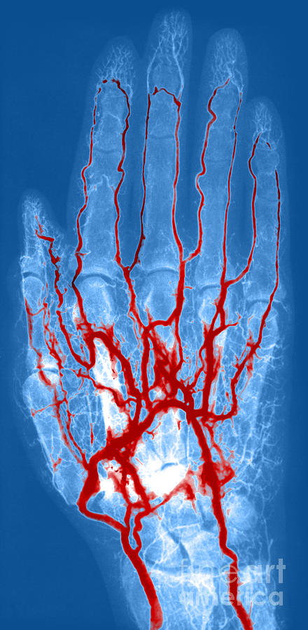 Hand Arteriogram #4 Photograph by Science Source