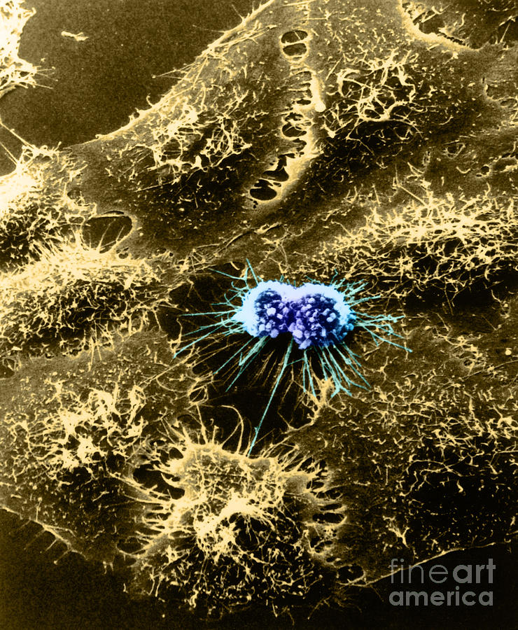 Hela Cells With Adenovirus #4 Photograph by Science Source