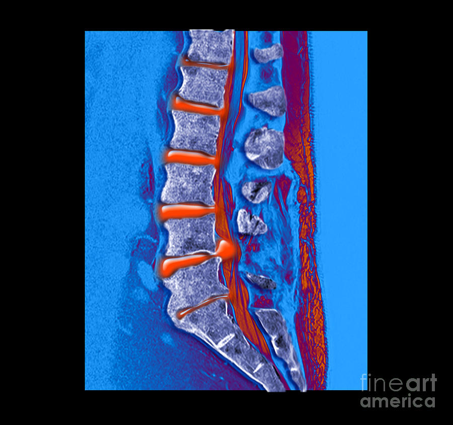 Herniated Disc #4 Photograph by Medical Body Scans