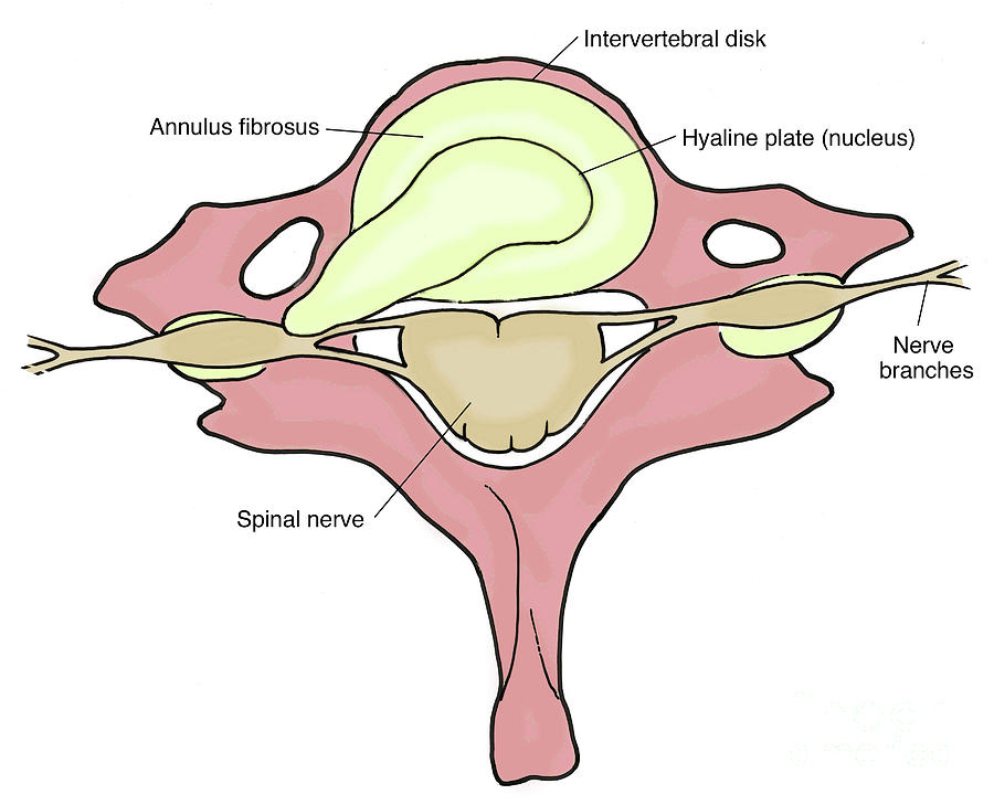 Illustration Of Herniated Spinal Disk Photograph by Science Source ...