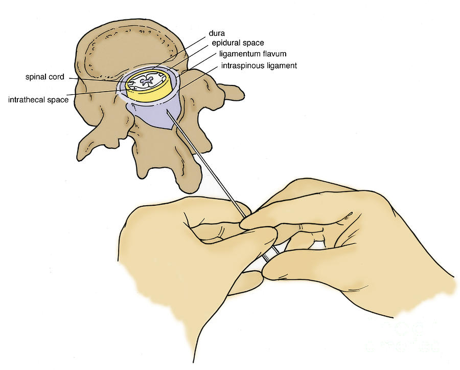 Lumbar Puncture Anatomy