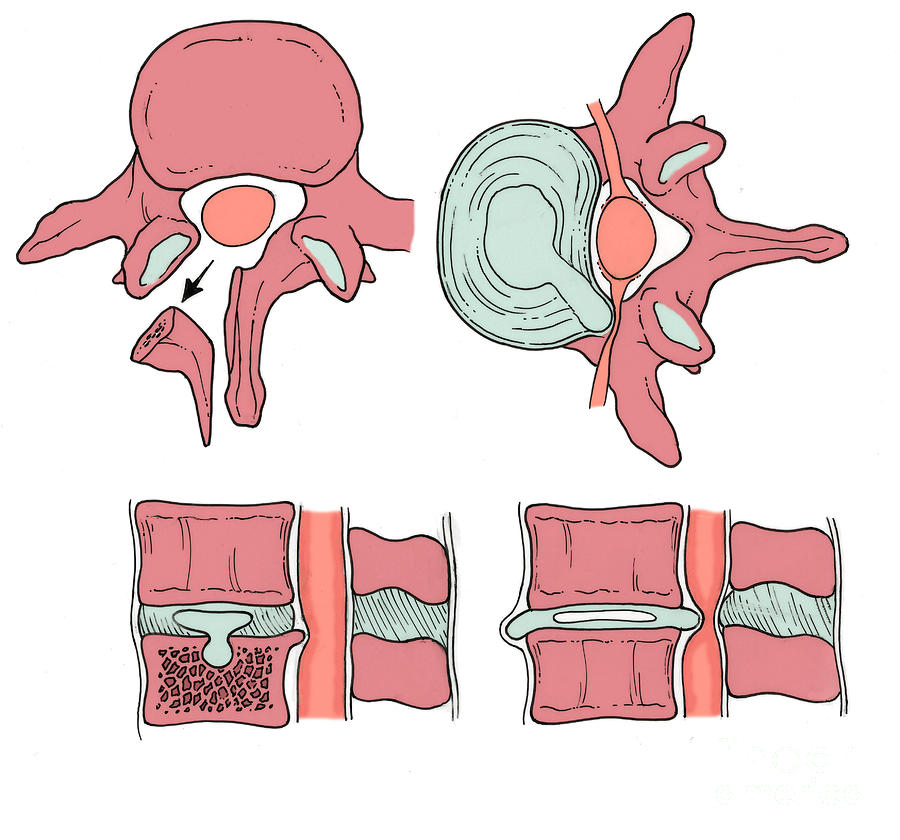 Illustration Of Spinal Disk Pathologies #4 Photograph by Science Source