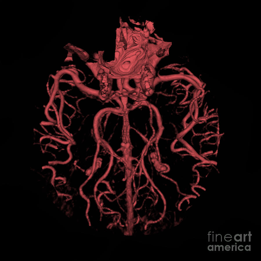 Intracranial Ct Angiogram #4 Photograph by Medical Body Scans