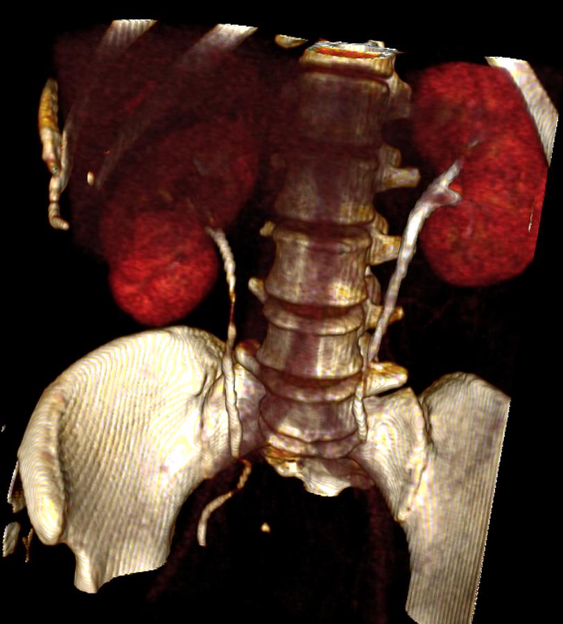 Kidney Damage, Ct Scan Photograph By Du Cane Medical Imaging Ltd - Fine 